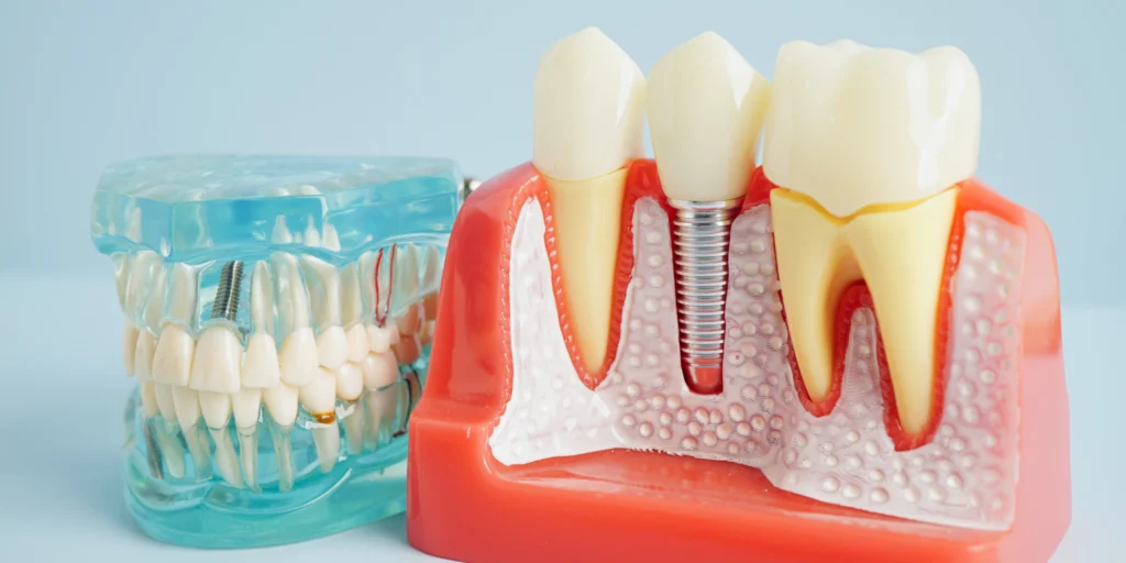 implant dentaire implant dentaire Implants dentaires Mediweb - Template 5