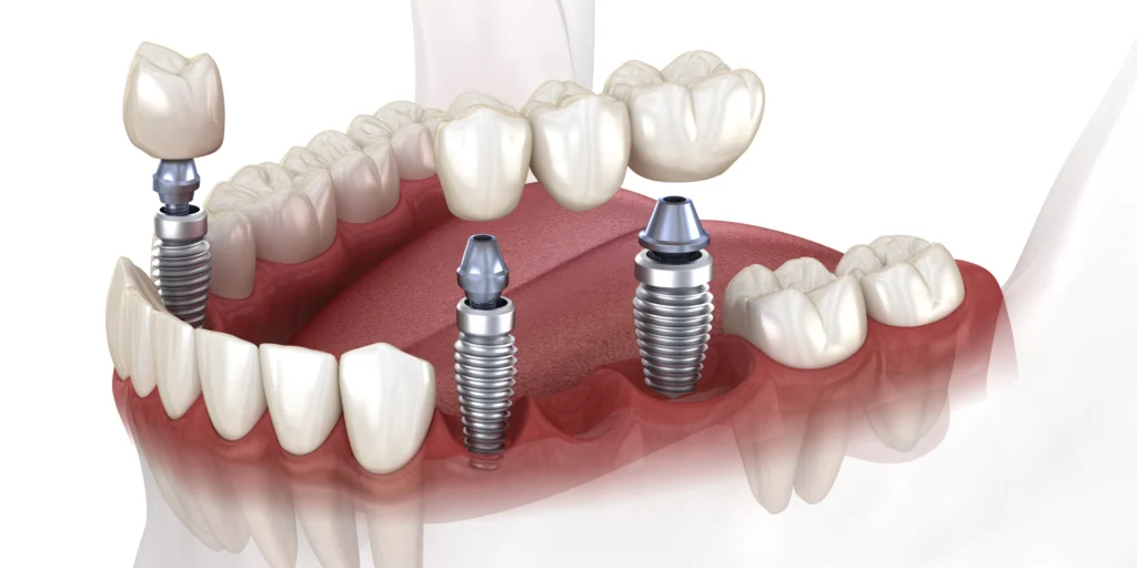 implant dentaire bridge implant dentaire bridge Implants dentaires Mediweb - Template 5