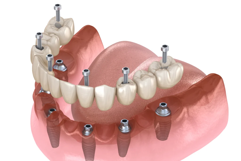 implant dentaire complet dentier implant dentaire complet dentier Implants dentaires Mediweb - Template 5