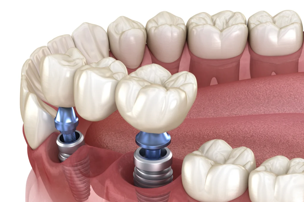 implant dentaire couronne bridge implant dentaire couronne bridge Implants dentaires Mediweb - Template 5
